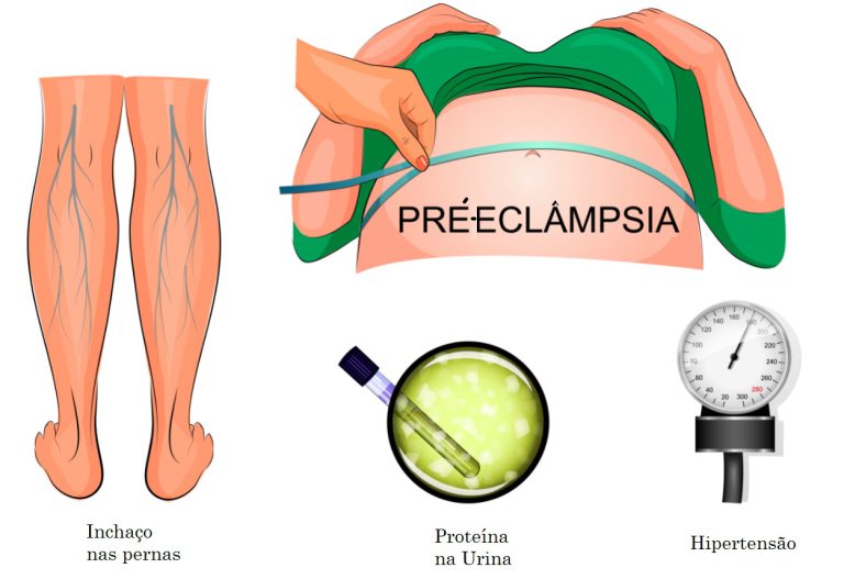 Pré-eclâmpsia: o que é, sintomas e tratamento - Clinica Viver