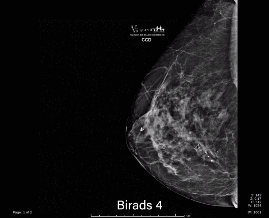 resultado de birads 4 - Achados mamográficos suspeitos