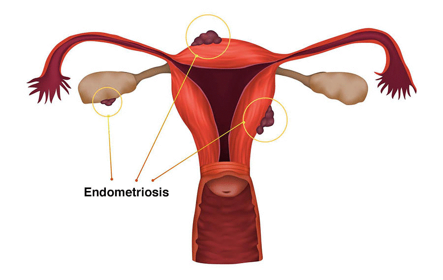 Endometriose o que é