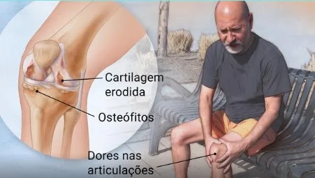 3 Doenças dos ossos: sintomas, diagnóstico e prevenção - Clínica Viver