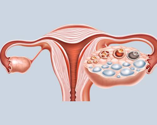 Teratoma de ovário pode se tornar câncer?