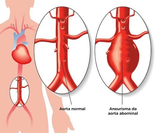 Aneurisma da aorta pode ser detectada pelo Ultrassom de abdômen total