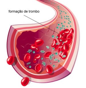 O que são trombos e como evitá-los